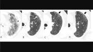 Serial transverse CT scans in a 65-year-old man with severe COVID-19 from 23-days after infection to 2-year follow up. The newest followup images on the right showed presence of subtle, subpleural honeycombing at the same area (black arrows). Image courtesy of Radiology. #longcovid #covidlonghauler #lungdamagecovid