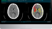 Brainomix stroke CT imaging 