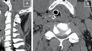 spinal cord injury on CT of patient with degenerative spinal changes