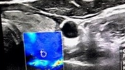 shear-wave elastography TIRADS