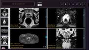 Learning app improves reader performance for prostate MRI