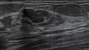 lesion on breast ultrasound