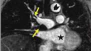 MRA for pulmonary embolus