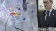 Video of ASE President Stephen Little, MD, discussing trends in interventional echo at the ASE 2023 annual meeting.