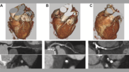 CTA images before TAVR to screen for coronary artery disease