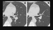 Lung cancer screening CT image in a 66-year-old male patient shows a sessile nodule with internal air in the left mainstem to left upper lobe bronchus (arrow) with a mean diameter of 10 mm. The nodule was assigned as Lung-RADS category 4A in the clinical report. (B) Follow-up CT image shows the lesion is resolved. Image courtesy of RSNA