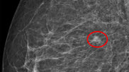 AI decision support tool used in breast cancer screening