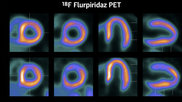 The new cardiac PET radiotracer flurpiridaz F-18 is posed to be a major game changer and will likely lead to increased adoption of cardiac PET.