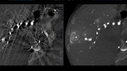 GE Healthcare's CleaRecon DL reduces IR image artifacts during procedures
