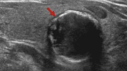 Predictive model helps identify malignancy in thyroid nodules.