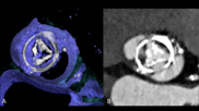 CT imaging showing structural valve deterioration. An example of structural valve deterioration that shows a biological prosthetic heart valve in the aortic position. There is severe calcification and thickening of the leaflets compatible with structural valve deterioration. 3D VRT (A) and in-plane reconstructions (B). Images and caption courtesy of Budde et al. and RSNA. 