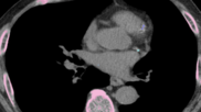 AI completes CAC assessment using routine LDCT scan