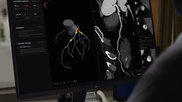 Australia-based Artrya Limited said its Salix Coronary Plaque module AI-powered cloud platform offers near-real time, point-of-care CCTA assessment and management of coronary artery disease. 