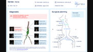 Nurea PRAEVAorta 2