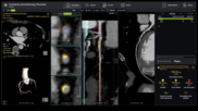 cvi42 | Plaque from Circle Cardiovascular Imaging 