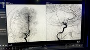 A stroke seen on a CT angiography showing a blockage to one side of the brain. Photo at the Philips booth at RSNA 2025. 