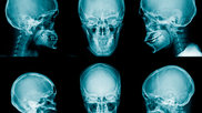 facial x-ray radiograph