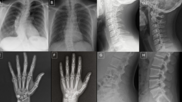 Deepfake X-rays trick radiologists and AI