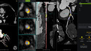 cvi42 | Plaque Circle Cardiovascular Imaging