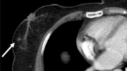 Most visible breast lesions are missed on chest CT scans