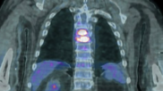 PET/CT excels at determining source of fever of unknown origin