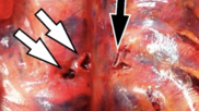 Rib fracture turns deadly after puncturing aorta