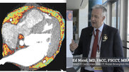 Ed Nicol, MD, FACC, FSCCT, MBA, FRCP, FRCR, FRAeS, head of cardiovascular CT, Royal Brompton Hospital, London, United Kingdom, and former president of the Society of Cardiovascular Computed Tomography (SCCT), explains some of the new technologies being developed to expand cardiac CT as a diagnostic tool.