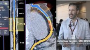 Jonathon Leipsic, MD, MSCCT, FRCPC, chairman of radiology, and a professor of radiology and cardiology, University of British Columbia, Canada, explains some of the key technical developments in coronary CT angiogram (CCTA) plaque imaging, which has seeing rapid adoption. #SCCT #TCT #YesCCT