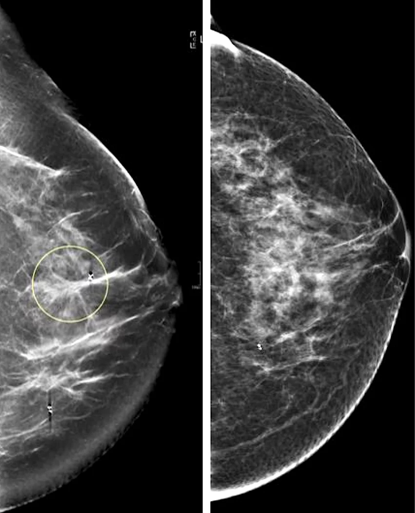 A comparison of standard 2D mammography (right) and digital breast tomosynthesis (DBT), or 3D mammography (left). The DBT creates a data set of 1 mm slices that the radiologist can look through to see more detail in suspect areas and determine if it dense breast tissue is masking a tumor.