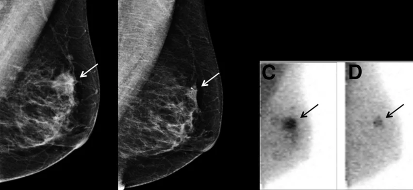 Mammography images (left) compared to molecular breast imaging (MBI) monitoring of tumor response to chemotherapy. Image from SNMMI.