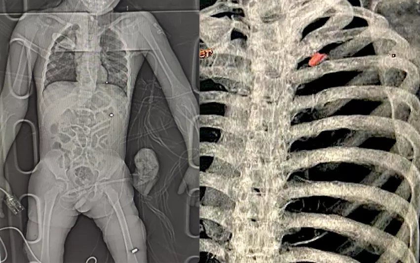 Radiology imaging of two wounded civilians with bullet and shrapnel embedded in tissue. Left is a digital X-ray of a patient with shrapnel in the chest and a bullet in the leg who was brought to the National Children's Specialized Hospital in Kyiv. Right, a 3D CT scan reconstruction of a bullet in the chest of a 40-year-old father who as attempting to evaculate his wife and child from the Russian advance near Kyiv when the Russians opened fire on him. Image from the Ukraine Heart Institute in Kyiv. 