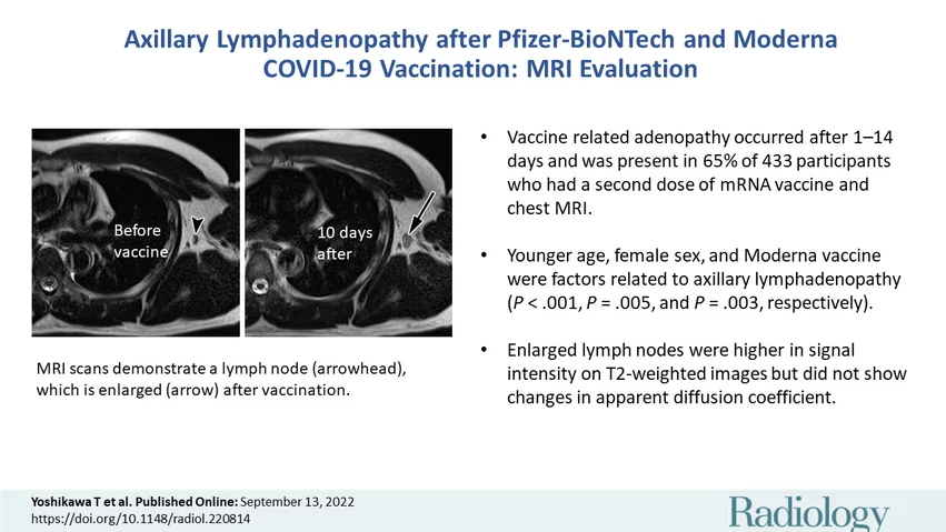MRI vaccine-related adenopathy MRI vaccine-related adenopathy