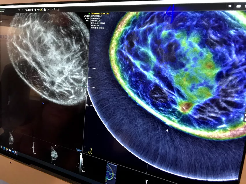 An example of the Delphinus whole breast ultrasound tomography technology. A ring transducer surrounding the breast creates an image of the whole breast, similar to MRI. It also uses reflection, sound speed and attenuation to characterize the tissue structure, as seen in the color-coded image, to help identify cancers.