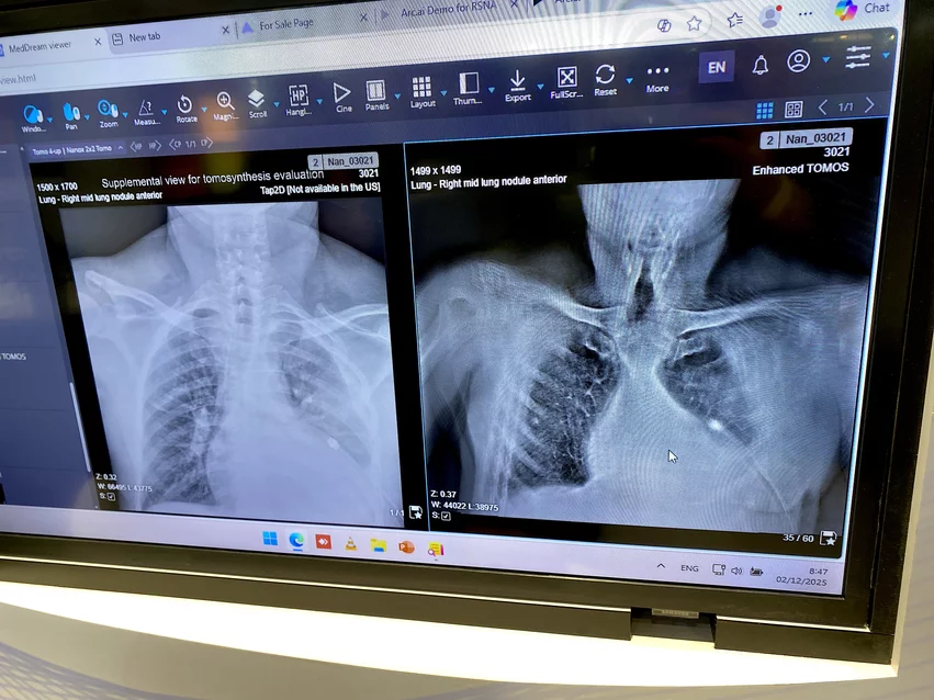 Рентгеновская визуализация и томосинтез, полученные с помощью системы Nanox с холодным катодом на выставке RSNA 2025.