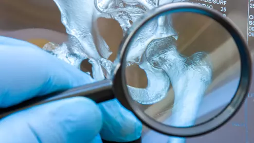 hip dysplasia joint socket