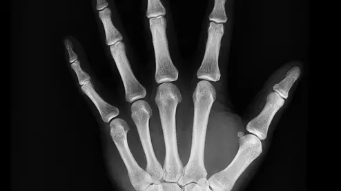 hand x-ray radiograph