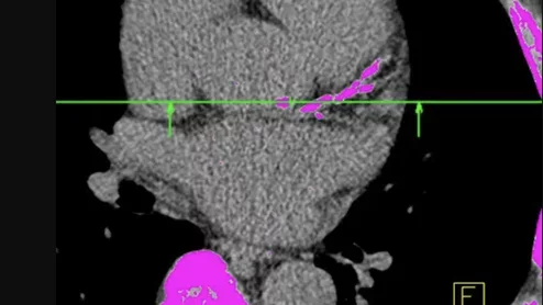 A low-dose CT coronary calcium scoring exam showing areas of calcified plaque and bone in pink.