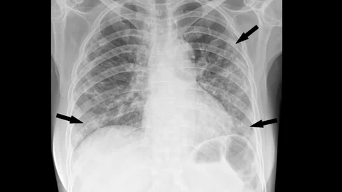 Chest radiograph in a 53-year-old woman with confirmed coronavirus disease 2019, or COVID-19, pneumonia. The patient had fever and cough for 5 days. Multifocal patchy opacities (arrows) can be seen in both lungs. Image courtesy of RSNA. What COVID looks like ob CT medical imaging.