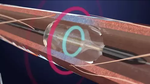 Recor Medical's Paradise Ultrasound Renal Denervation System