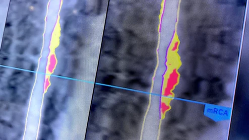 Cleerly AI plaque and coronary artery analysis at SCCT 2023. Photo by Dave Fornell