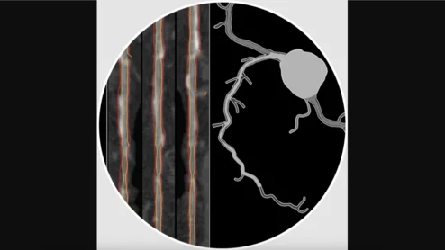 HeartFlow Plaque Analysis