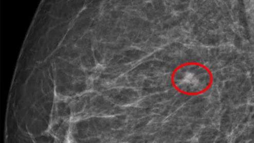 AI decision support tool used in breast cancer screening