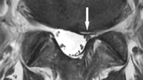 Rads' lumbar MRI reads more accurate when they have access to patients' self-reported symptoms