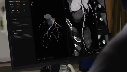 Australia-based Artrya Limited said its Salix Coronary Plaque module AI-powered cloud platform offers near-real time, point-of-care CCTA assessment and management of coronary artery disease. 