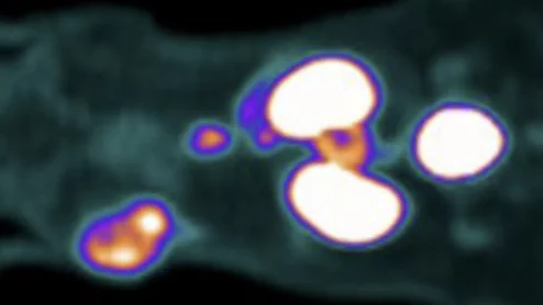 Dual-mode radiotracer helps surgeons 'hear' invisible cancer lesions