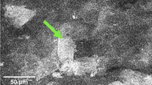 Fluorescent contrast agent helps diagnose basal cell carcinoma.