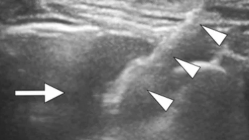 Ultrasound guidance a safer, more accurate method for biopsies of peripheral lung lesions in children