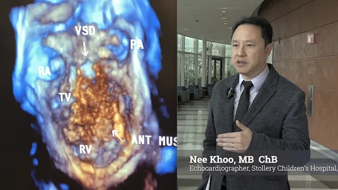Dr. Nee Khoo, director of the echocardiography lab, Stollery Children’s Hospital, Edmonton, Canada, explains the rapidly growing adoption of pediatric 3D transesophageal echo (TEE) to not only preplan, but also guide and assess the results of congenital heart surgeries.