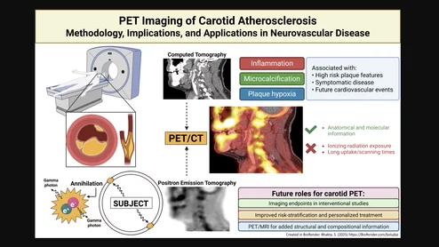 Positron emission tomography (PET) nuclear imaging has seen rapid expansion in cardiology and oncology due to its improve accuracy over SPECT and its ability to expand into new areas of cardiovascular imaging. A new review in the American Heart Association journal Stroke outlines another possible use of PET to assess carotid artery atherosclerosis for stroke prevention. Figure courtesy Stroke, https://www.ahajournals.org/doi/10.1161/STROKEAHA.125.050399