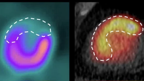 PET study targets inflammation to predict AMI recovery